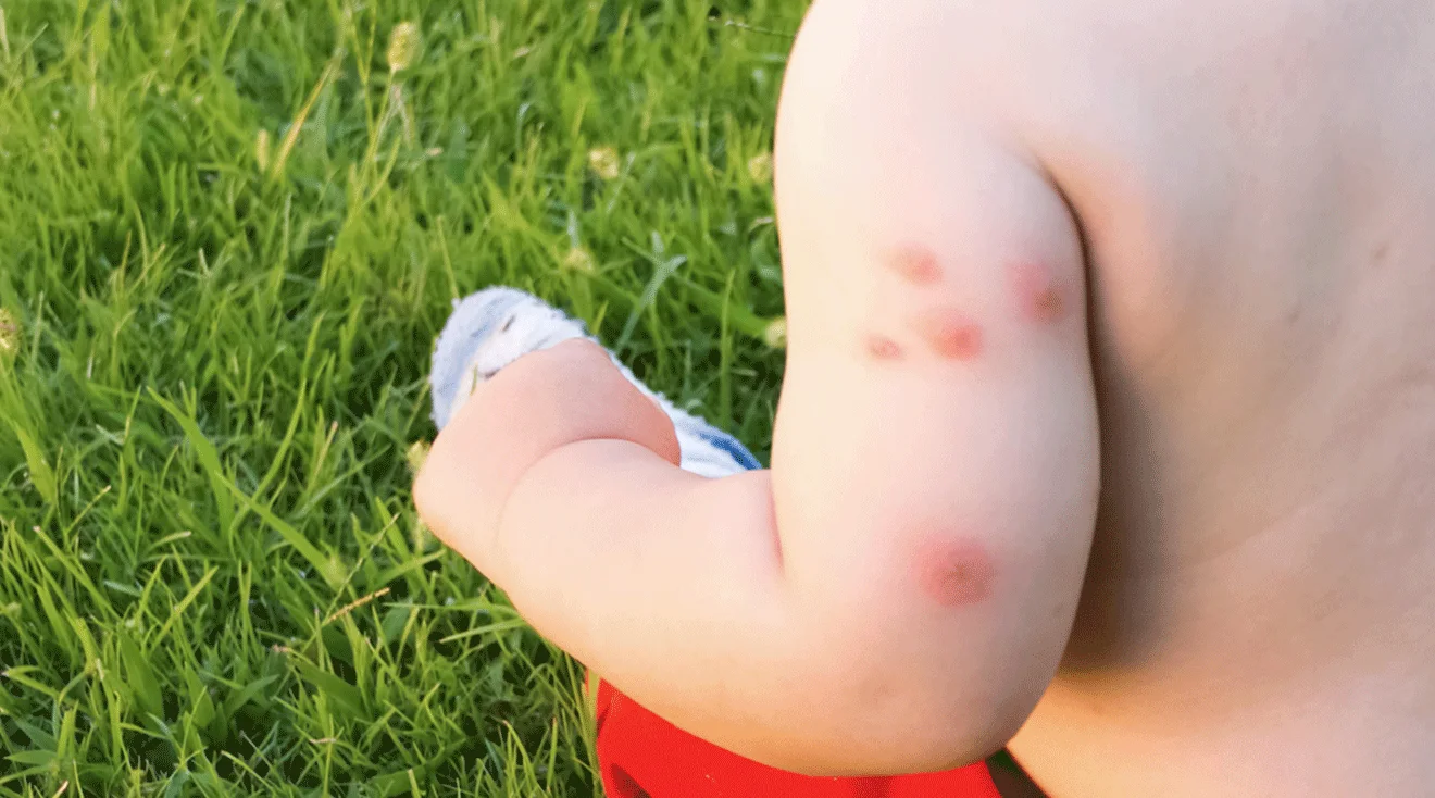 hild’s upper arm with multiple red circular insect bites on skin