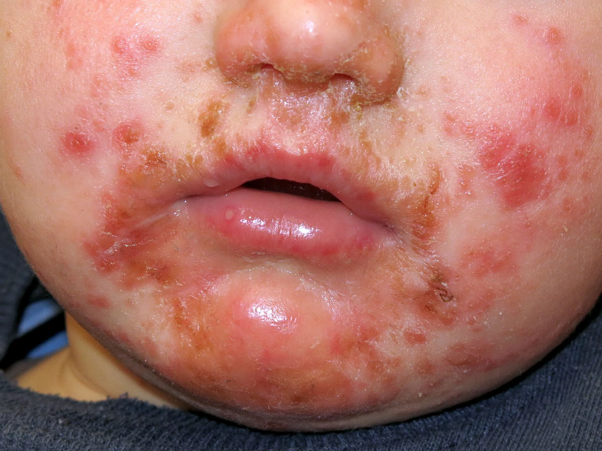 Child with inflamed red lesions and crusting around mouth and cheeks