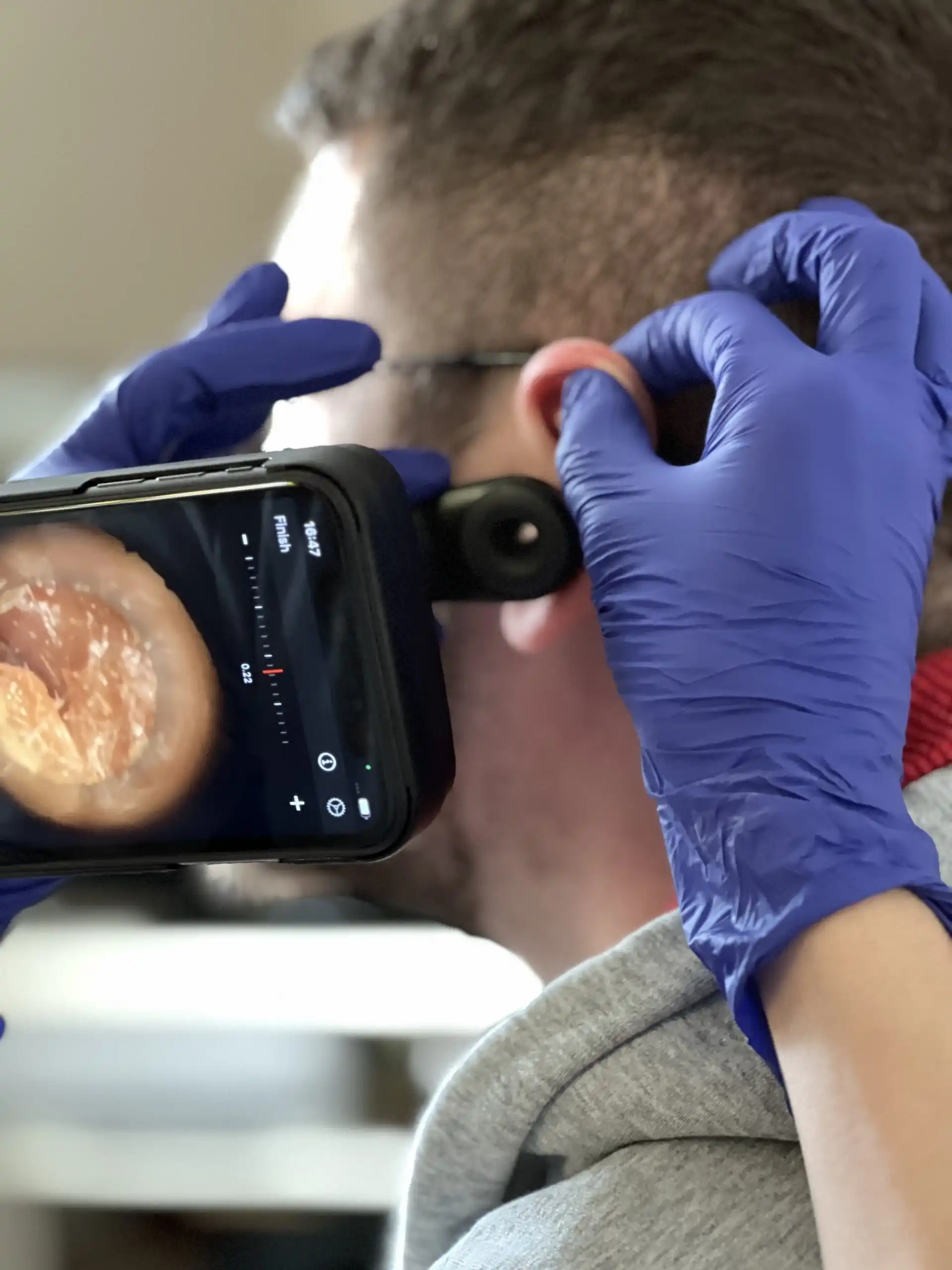 Microsuction Earwax removal